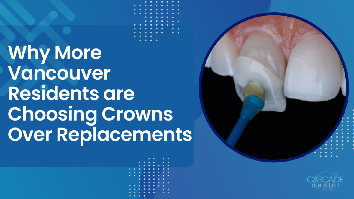 Why More Vancouver Residents are Choosing Crowns Over Replacements